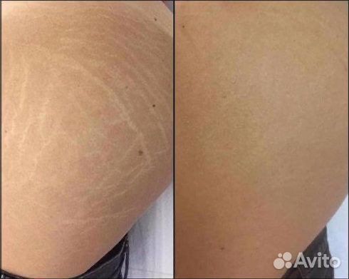 Татуаж шрамов