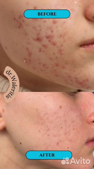 Косметология чистка лица