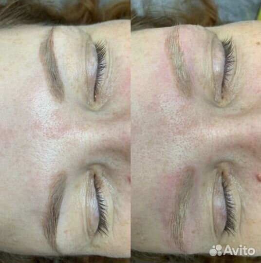 Удаление татуажа и тату