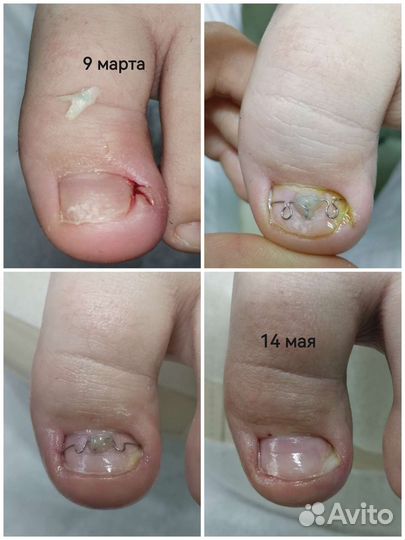 Снятие гель-лака с ногтей на ногах