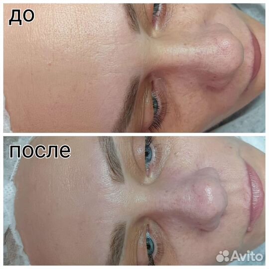 Чистка лица, эстетическая косметология