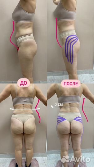 Тейпирование