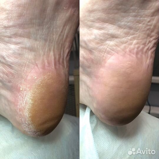 Медицинский педикюр подолог