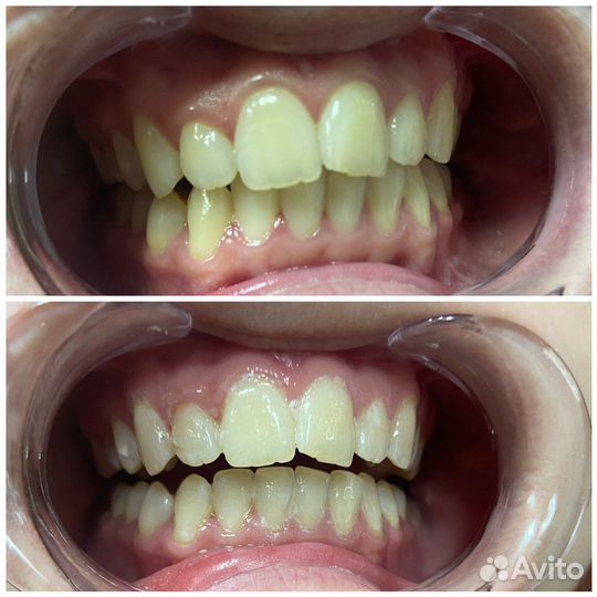 Косметическое отбеливание зубов