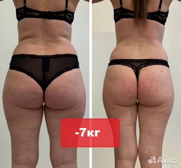 Аппаратный массаж. Антицеллюлитный. Коррекция фигу