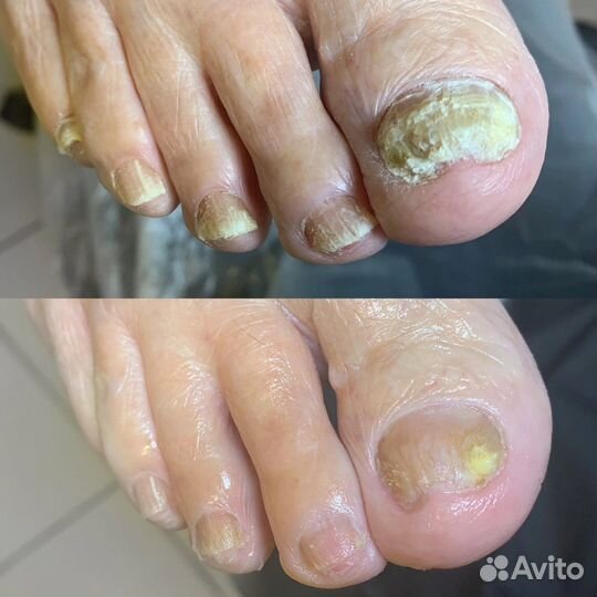 Подологический педикюр