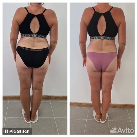 Lpg-массаж, rf-лифтинг, кавитация, прессотерапия