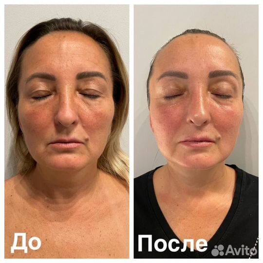 Скульптурный массаж лица