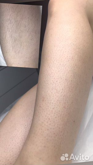 Восковая депиляция