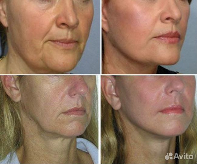 Модель на RF-Лифтинг (абсолютно бесплатно)