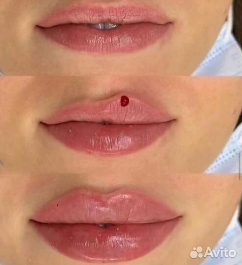 Модели на увеличение губ и ботекс(лоб, глаза, межб