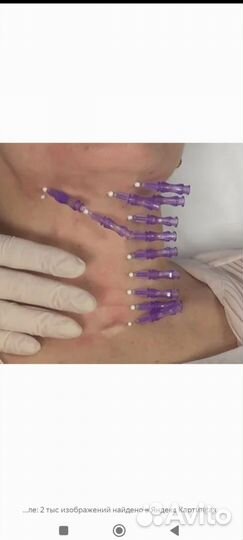 Нитевой лифтинг