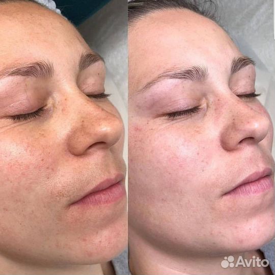 Модели на Карбокситерапию лица бесплатно