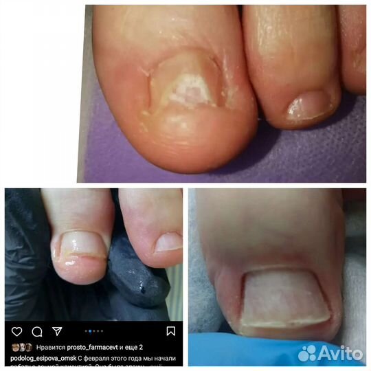 Педикюр аппаратный.парамедицинский