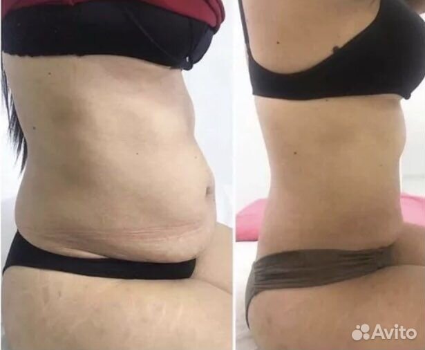 Криолиполиз,кавитация,карбоновый пилинг,эндо360