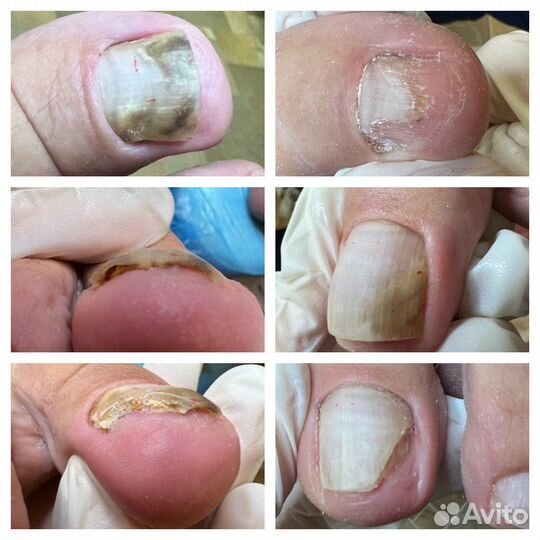 Педикюр сложных стоп