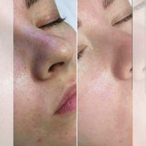 Пилинг лица/ желтый пилинг/ мезопилинг