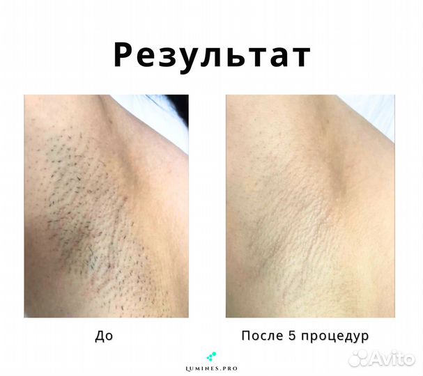 Аппарат для эпиляции Lumines’ Макс Ван 1200 Вт