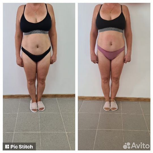 Lpg-массаж, rf-лифтинг, кавитация, прессотерапия