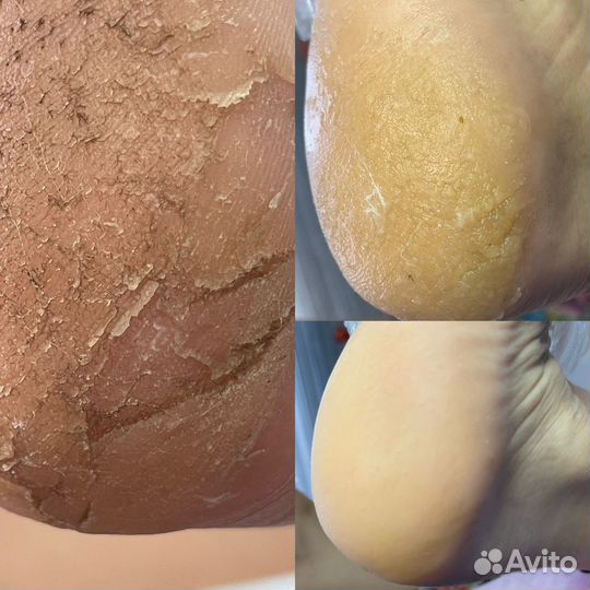 Педикюр. Подология