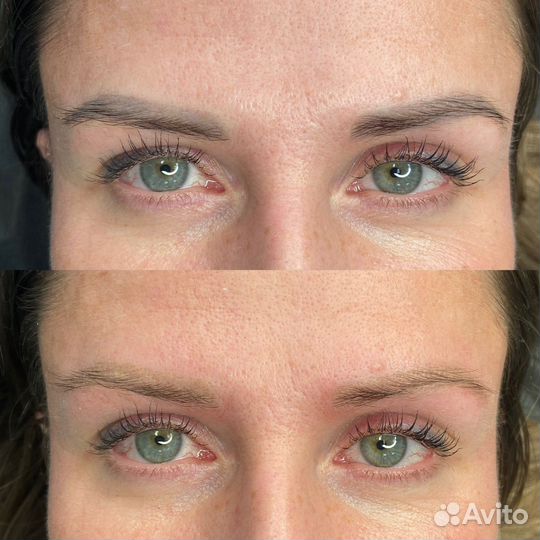 Лазерное удаление тату и татуажа