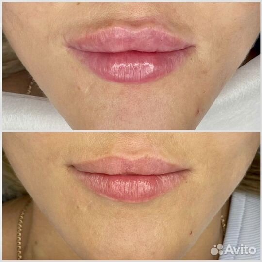 Коррекция губ, увеличение губ