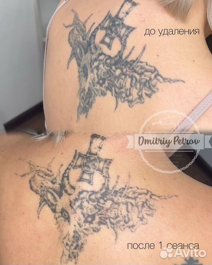 Удаление татуажа бровей/тату