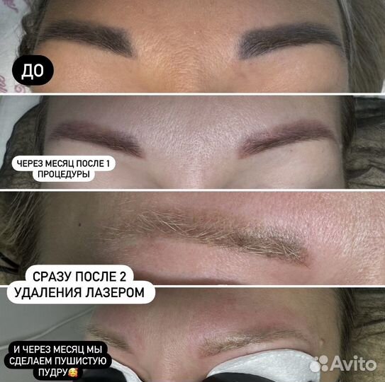 Лазерное удаление татуажа/тату