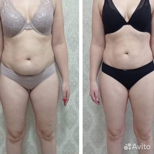 Аппаратное похудение Коррекция фигуры