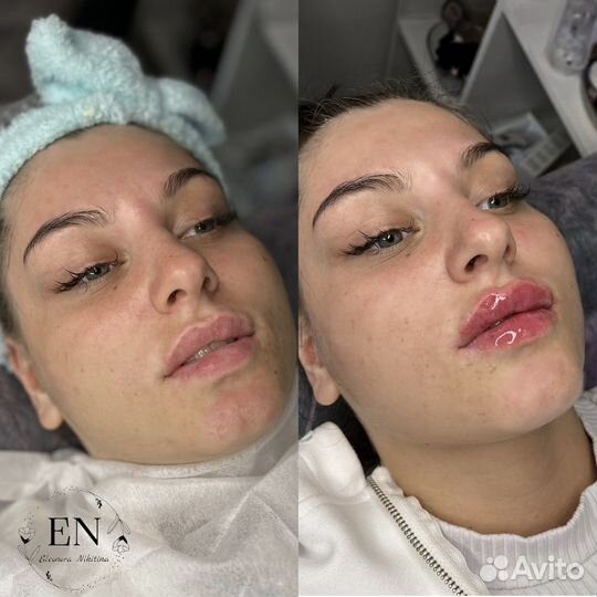 Косметолог:увеличение губ,ботокс,чистка,full face
