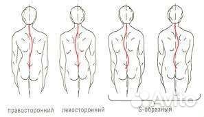 Скалиоз, массаж при скалиозе