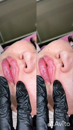 Биоревитализация