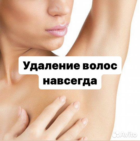 Электроэпиляция