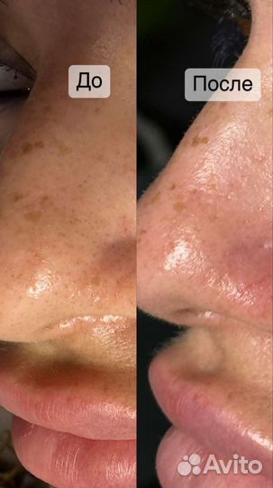 Косметолог Чистка лица Пилинг Биорепил