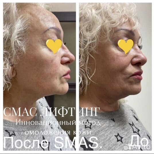 Смас лифтинг