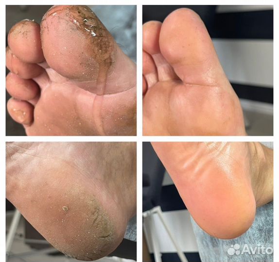 Педикюр,педуход с покрытием гельлак