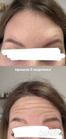 Ботокс для лица модель