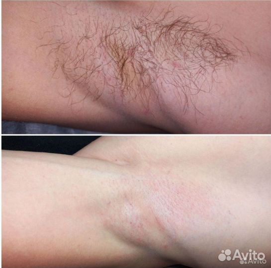 Восковая депиляция