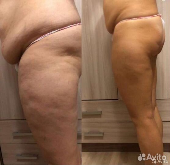 Антицеллюлитный массаж