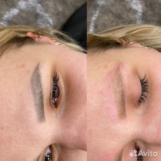 Лазерное удаление тату татуажа