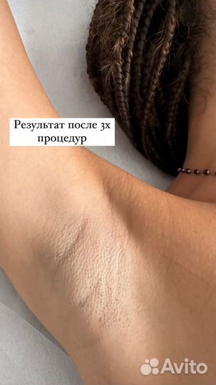 Лазерная эпиляция