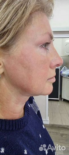 Смас лифтинг