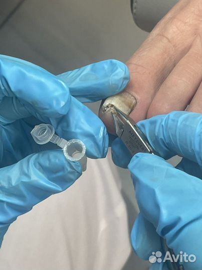 Педикюр лечебный - подолог