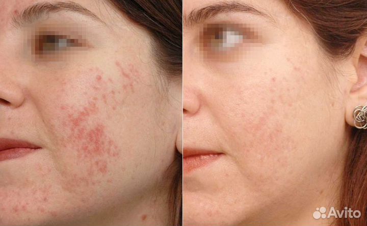 Лечение акне и постакне аппаратное