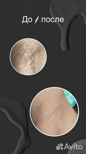 Шугаринг на дому