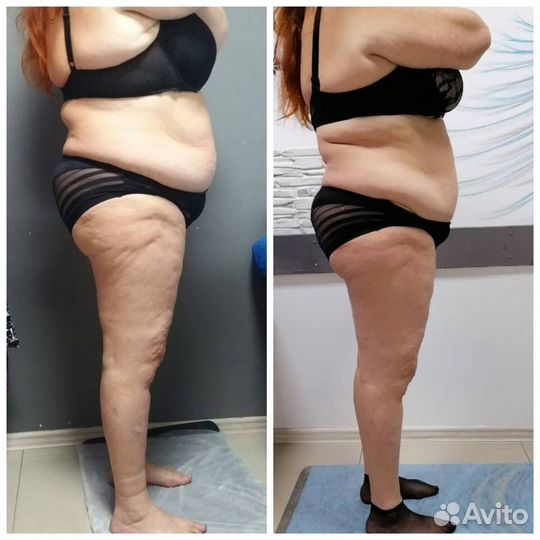 LPG массаж антицеллюлитный для похудения