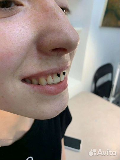 Пирсинг, микродермал