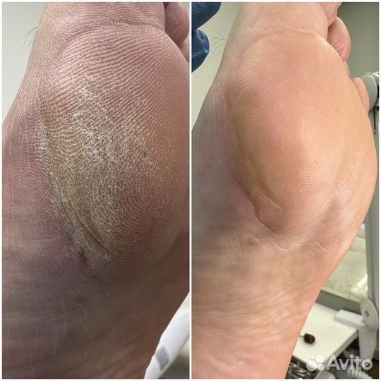 Педикюр подолог