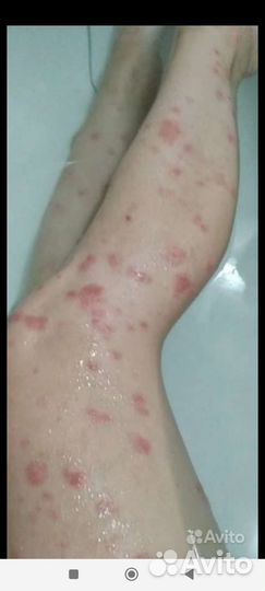 Мазь от псориаза