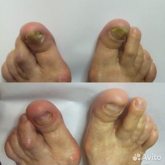 Медицинский педикюр, подолог